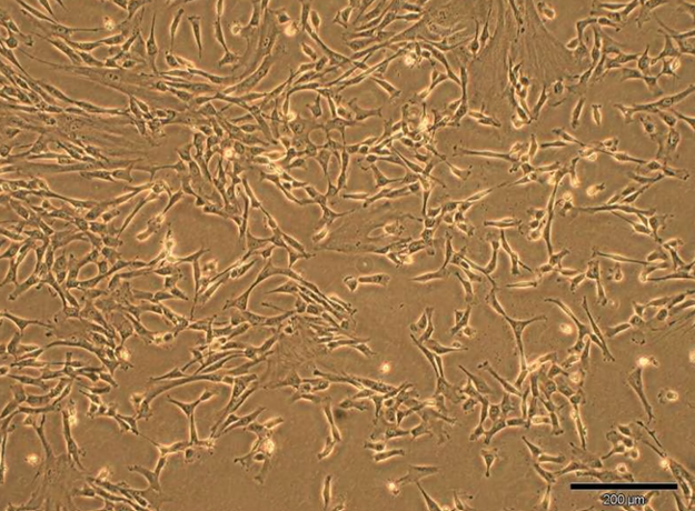 اولین درمان موفقیت‌آمیز فشار خون شدید ریوی با سلول‌های بنیادی بند ناف